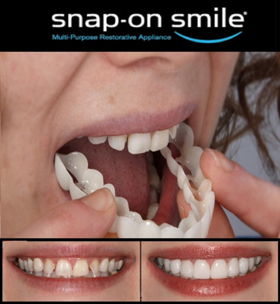 Snap On Smile Teeth Decoration Kit